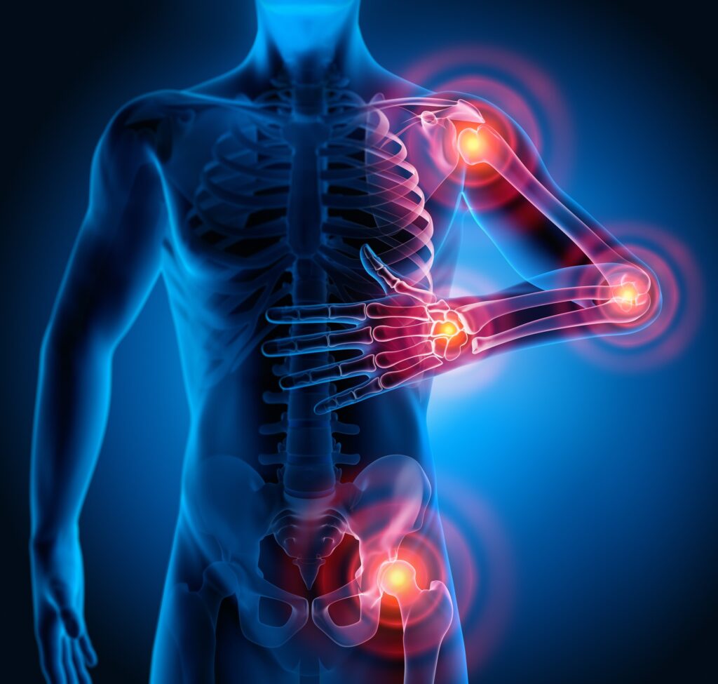 An image showing where the joint issues can be in the human body